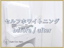 ライトケアサロン 銀座店(Light Care Salon)/セルフホワイトニングの症例写真