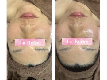 エステテックサロンラレーヌ 小山店(La Reine)/Vフェイスラインに☆