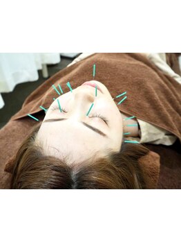 鍼灸施術を受けたい