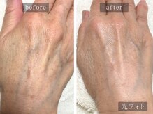 アムールサロン(Amour salon)/光フェイシャルでシミケア/新宿