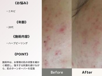 ルディラ 上野店/ハーブピーリング