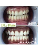 ルブラン 奈良店(Le Blanc)/自分への投資にホワイトニング