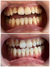 白の雫/歯科提携ホワイトニング