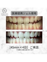 ラクナ ホワイトニング(RAKUNA)/歯科医提携ホワイトニング症例