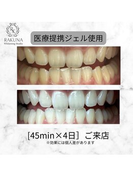ラクナ ホワイトニング(RAKUNA)/歯科医提携ホワイトニング症例