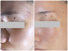 キレイ(KIREI)/before　＆　after