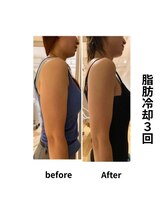 エミット(emit.)/脂肪冷却　ビフォーアフター