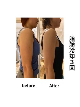 エミット(emit.)/脂肪冷却　ビフォーアフター