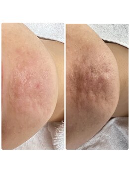 クワ(Cuwa)/鼻だけではなく顎もツルツルに