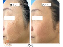 サロンドフルール/リセラ「ADS」肌改善プログラム