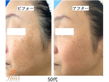 サロンドフルール/リセラ「ADS」肌改善プログラム