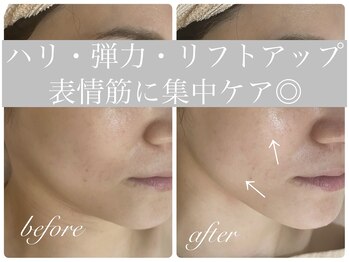 アリスビューティー(AliceBeauty)/リフトアップなら！