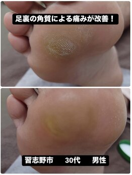 巻き爪じゅん 船橋店/足の角質によるストレスから解放