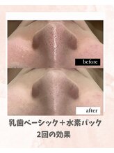 リンフェイス 浦安店(RINFACE)/ハイドラで頑固な毛穴ケア