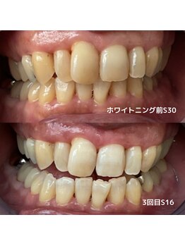ホワイトニングビューティー 行橋店/3来店で7トーンアップ☆