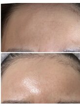 マリエンドリー/おでこのシワ　眉間のシワ