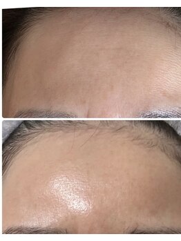 マリエンドリー/おでこのシワ　眉間のシワ