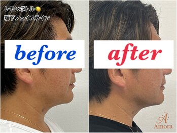 アモーラ(Amora)/レモンボトル顎下