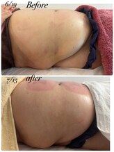 ソルツーサロン マナ(MANA)/脂肪冷却も驚きの効果