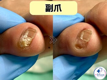 プラスワンフット 本厚木(+1 Foot)/走ると痛む小指の副爪・魚の目