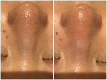 クランシュプール 恵比寿店/【毛穴のつまり/ニキビケア】