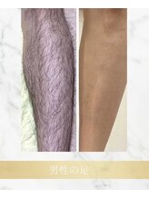 アンド エヌ(&n)/◆足脱毛◆