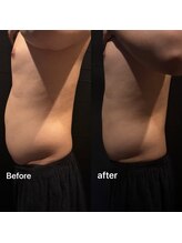 ビトタン 倉敷本店(+美to鍛)/脂肪を分解★１回での効果