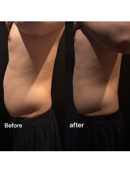 ビトタン 倉敷本店(+美to鍛)/脂肪を分解★１回での効果