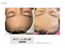 ヴィヴァーチェ(Vivace)/おでこ　Before→after