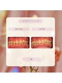 プラスビーセルフ(+b self)/ホワイトニングビフォーアフター
