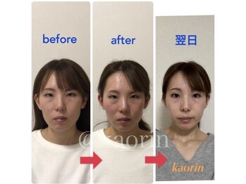 顔凛(カオリン)/翌日まで変化する小顔矯正