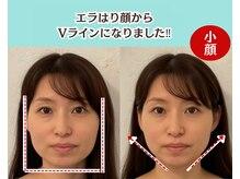 ピュアハリ/沖縄美容鍼 効果