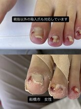 巻き爪じゅん 千葉駅前店/親指以外の陥入爪も改善へ