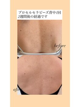 プラージュ(plage)/プロセルセラピーズ背中