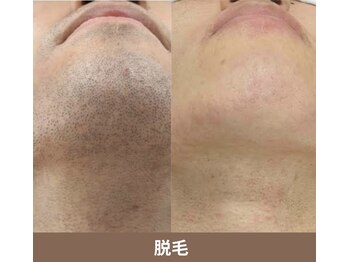 アポロ(Apollo)の写真/《メンズ専門サロン◇高技術×丁寧》メンズ脱毛は当たり前の時代！全身脱毛や人気のひげ脱毛もお任せ♪
