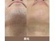 アポロ(Apollo)の写真/《メンズ専門サロン◇高技術×丁寧》メンズ脱毛は当たり前の時代！全身脱毛や人気のひげ脱毛もお任せ♪