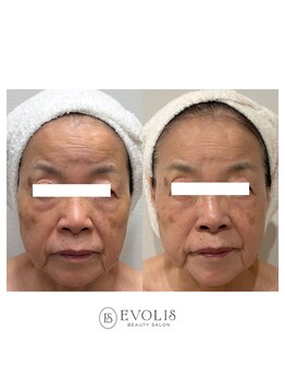 エヴォリス(EVOLIS)の写真/EVOLIS式小顔マッサージだけでなく背中・デコルテ・頭皮もしっかりマッサージ◎