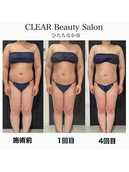 クリア(CLEAR)/リヴァイセルボディ　