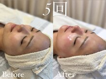 ザ パールズ(The Pearls)/5回継続後のビフォーアフター☆