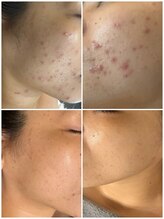 エリー(ERIE)/繰返す肌荒れから脱出！肌質改善