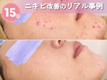 ロエヴェ(ROEWE)の雰囲気（ニキビ改善、ニキビ予防、ニキビ後のケアは実績豊富な専門店へ♪）