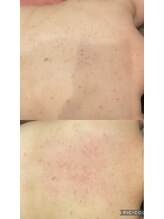 ルナート(Lunart)/ハーブピーリング【背中】