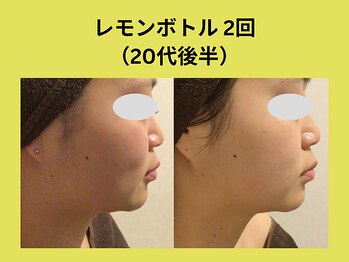 アユアランリンク 札幌店/レモンボトル20代後半/2回