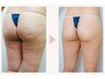【初回限定/引き締めて“魅せる体”へ】セル脂肪ケア◎エンダモロジー＆EMS