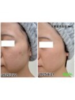 アップル 御幸ヶ原店(Apple.)/肌質改善プログラム