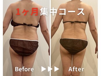 エピデリ 福岡大濠(EPI de RIZ)/【痩身/ダイエット】1ヶ月集中