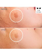 ルミラポー(Lumira Peau)/40代3回