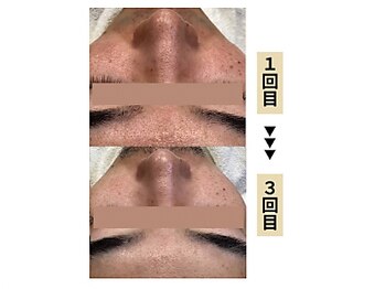 グラツィア(Grazia)/毛穴エステ