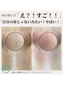 エクシア(Excia)/毛穴洗浄