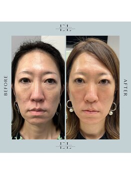 スプレール 水戸店/ExoLif(エクソリフト)